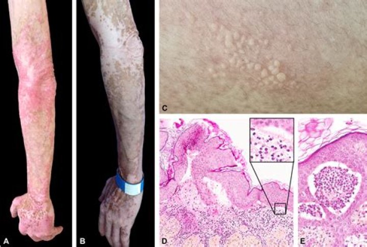 How is bullous lupus treated?