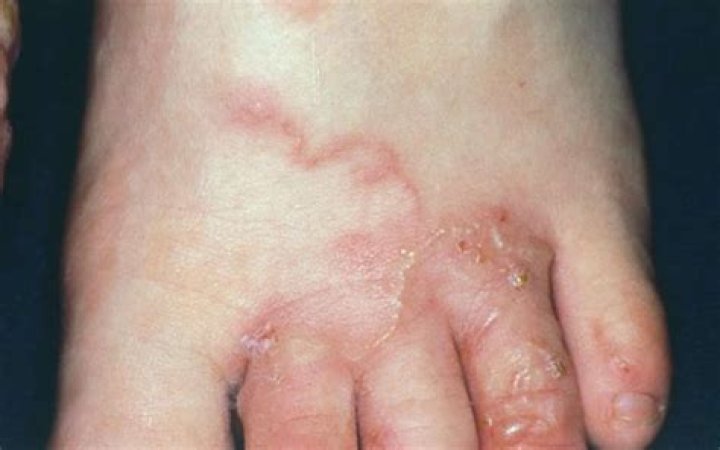 How is creeping eruption diagnosed?
