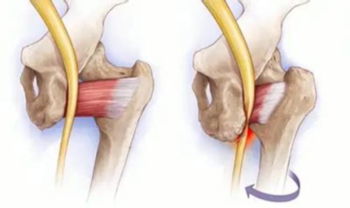 How is ischiofemoral impingement treated?