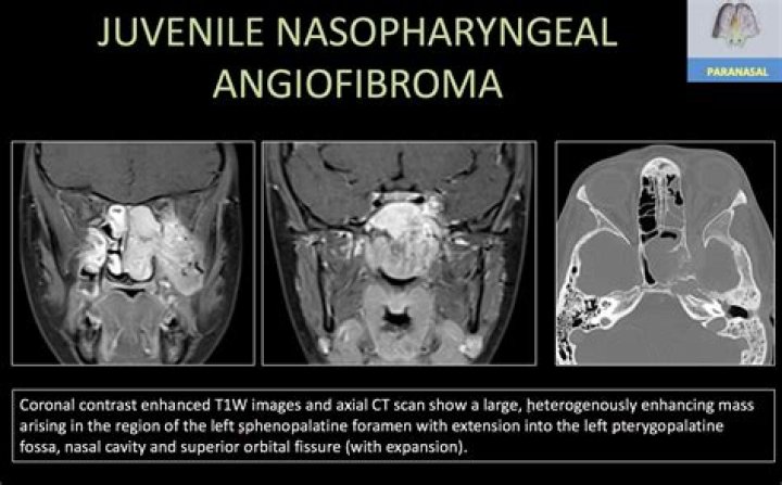 How is juvenile angiofibroma diagnosed?