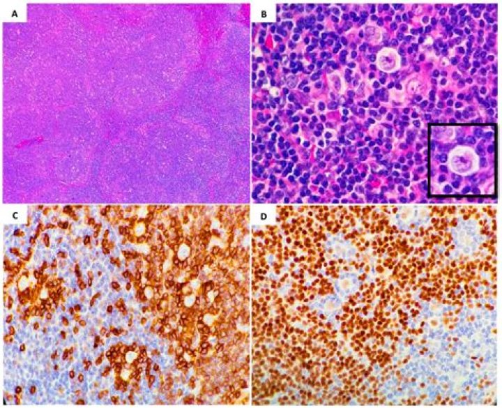 How is nodular lymphocyte predominant treated?