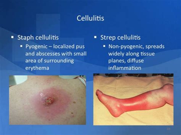 How is Pseudomonas cellulitis treated?
