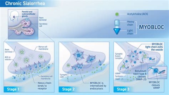 How is sialorrhea treated?