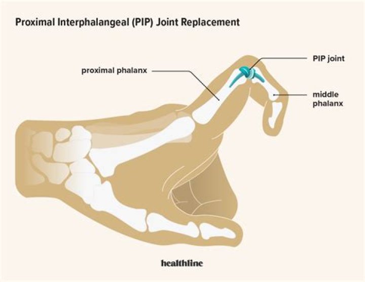 How long do PIP implants last?