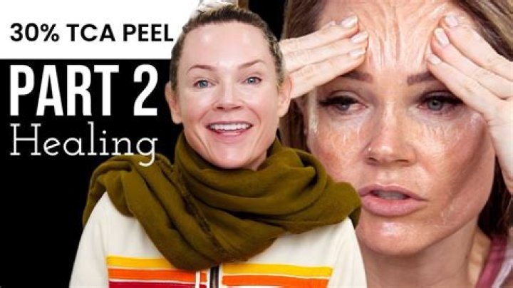 How long do TCA peels take to heal?