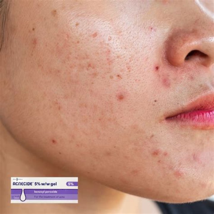 How long do you leave Acnecide gel on for?