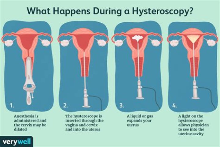 How long does a hysteroscopy surgery take?