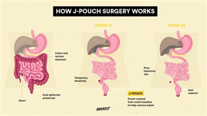 How long does IPAA surgery take?
