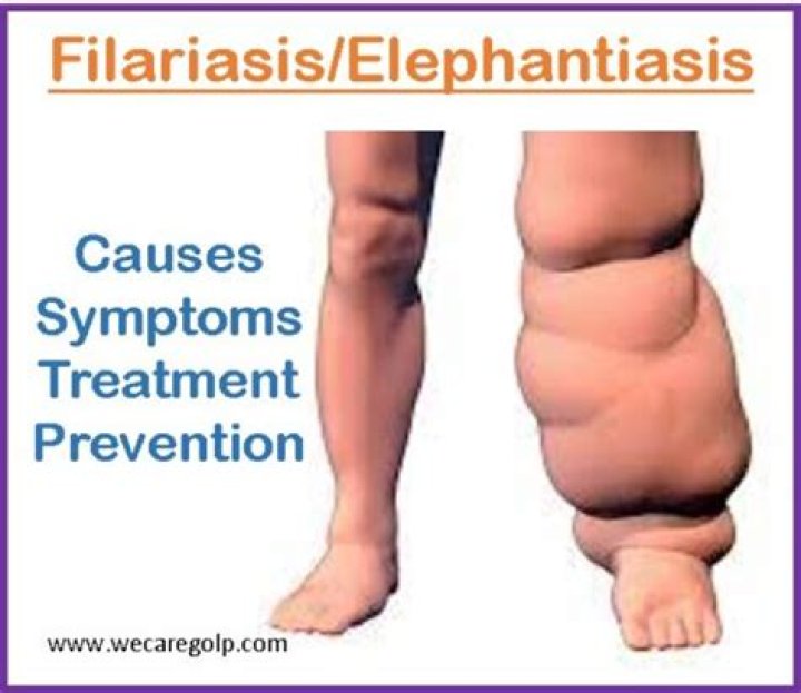 How long does it take to cure filariasis?