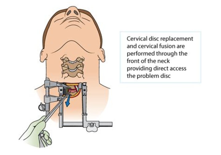 How long does it take to recover from disc replacement in the neck?