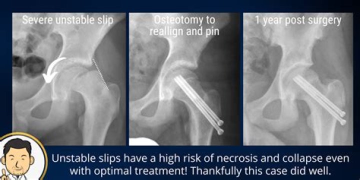 How long does it take to recover from SCFE surgery?