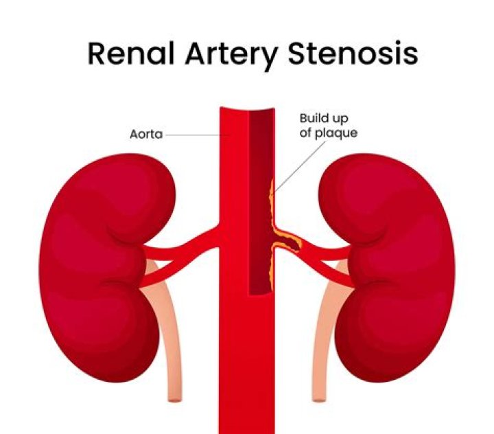How long is renal artery stenosis surgery?