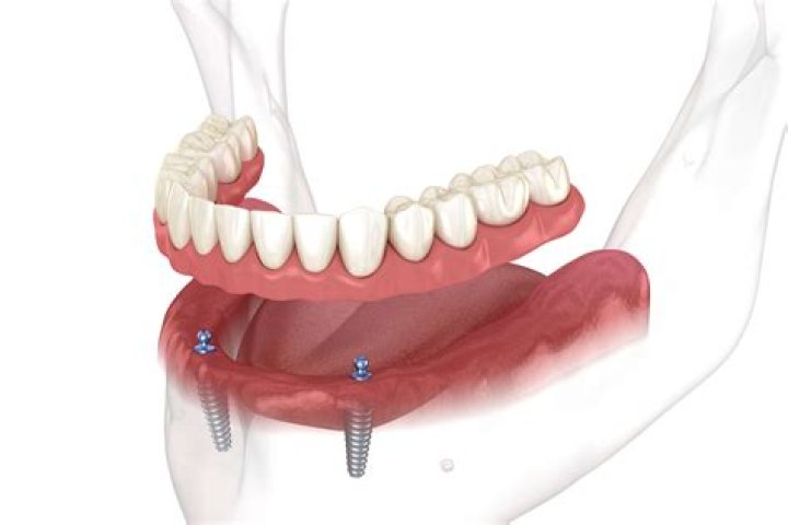 How many implants are needed for overdenture?