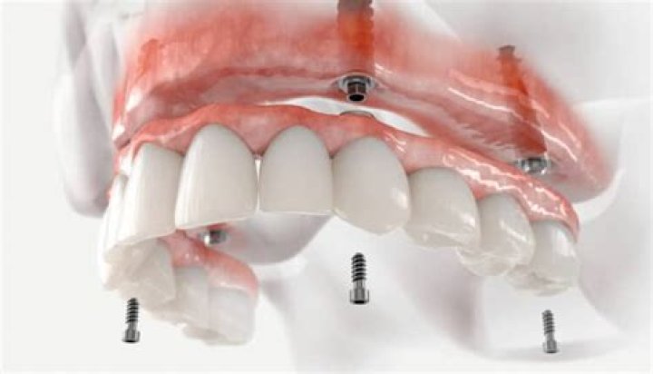 How much are mini implants in Mexico?