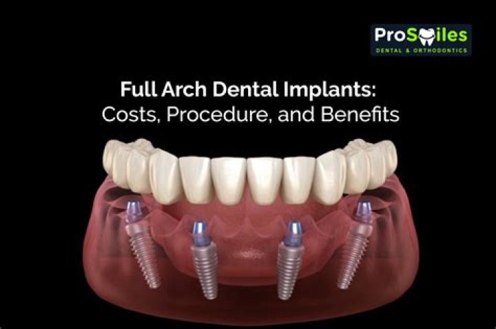 How much does a full arch dental implant cost?