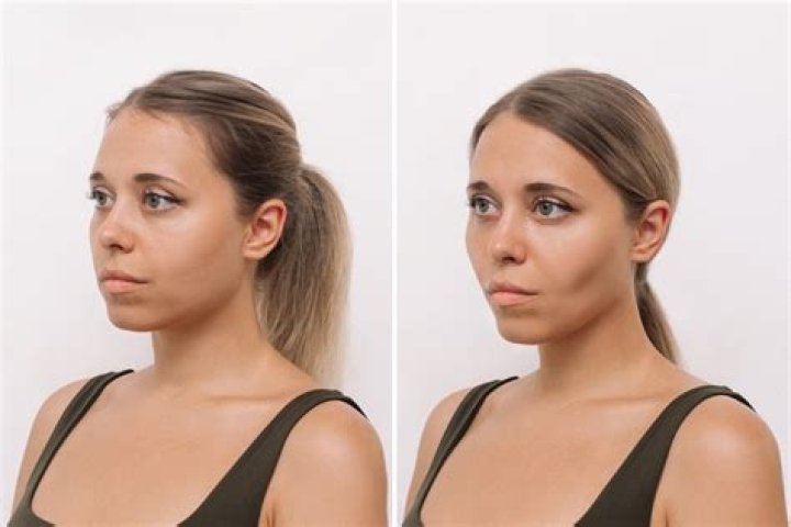 How much does Smart Lipo cost for neck?