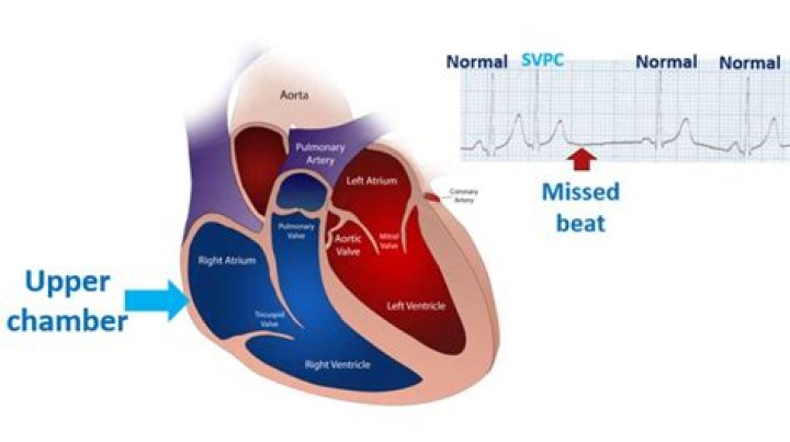 How serious is supraventricular Ectopy?