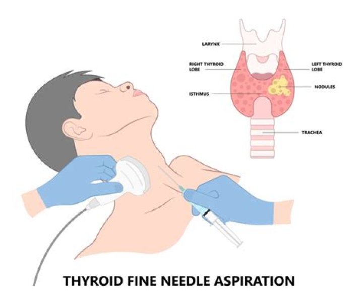 Is a needle biopsy of a thyroid nodule painful?