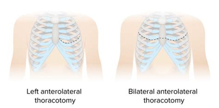 Is a thoracotomy minimally invasive?