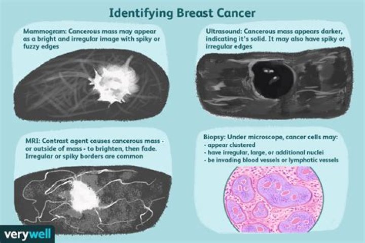 Is benign breast disease cancerous?