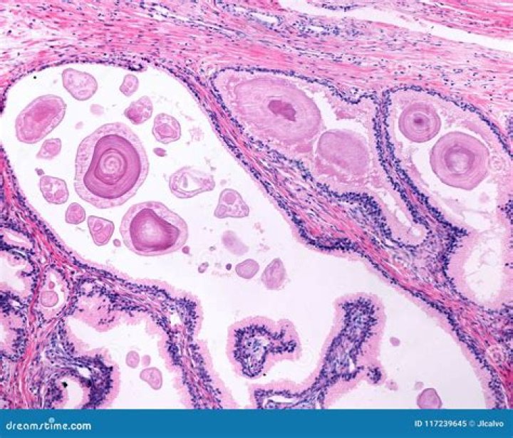 Is corpora amylacea normal in prostate?