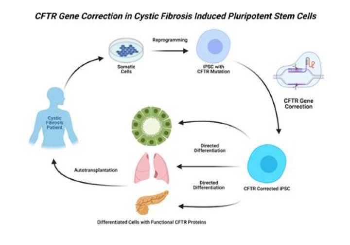 Is cystic fibrosis curable with gene therapy?