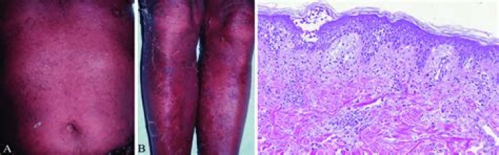 Is erythroderma life threatening?