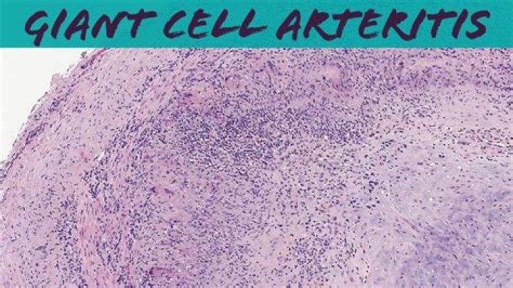 Is giant cell arteritis large vessel?