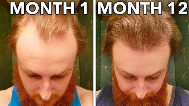 Is hairline damage reversible?