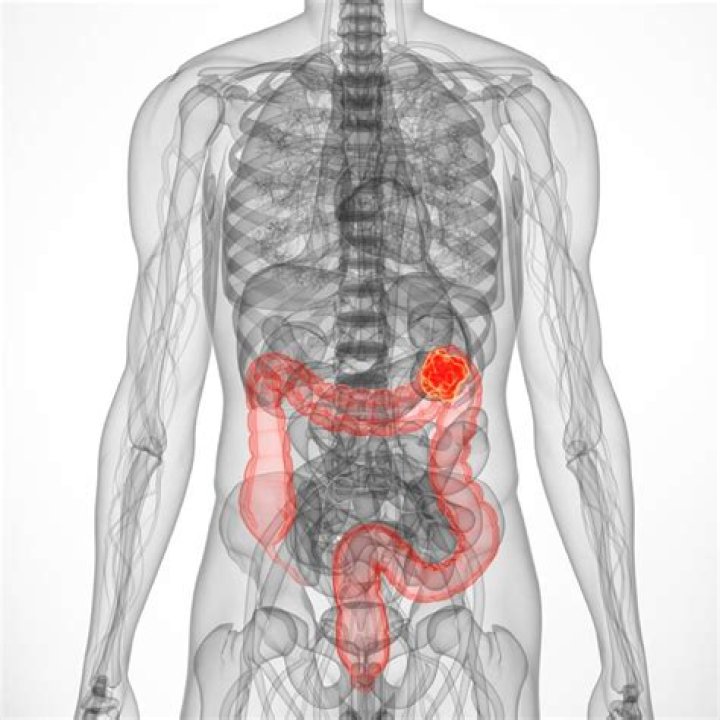 Is Hemangioblastoma a cancer?
