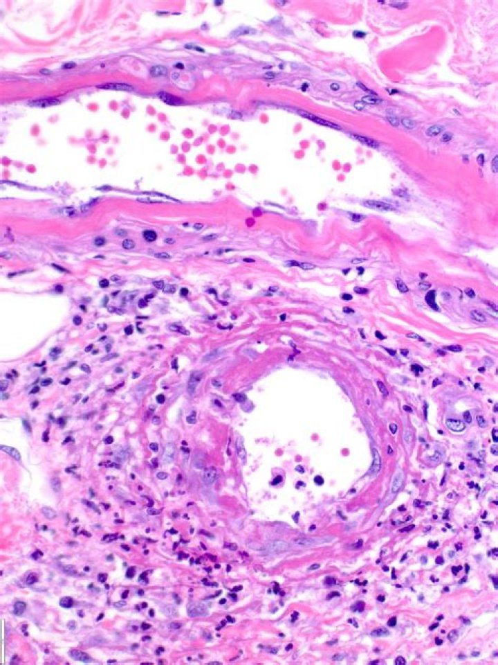 Is Henoch Schonlein purpura palpable?