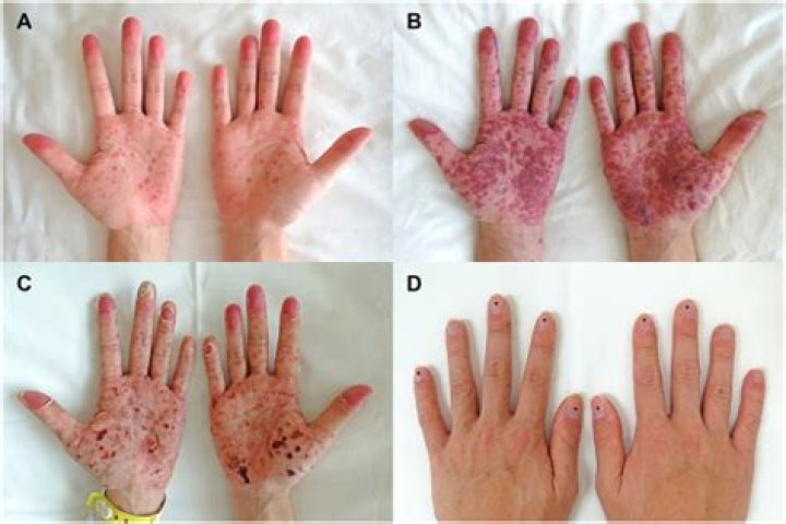 Is HFMD worse in adults?
