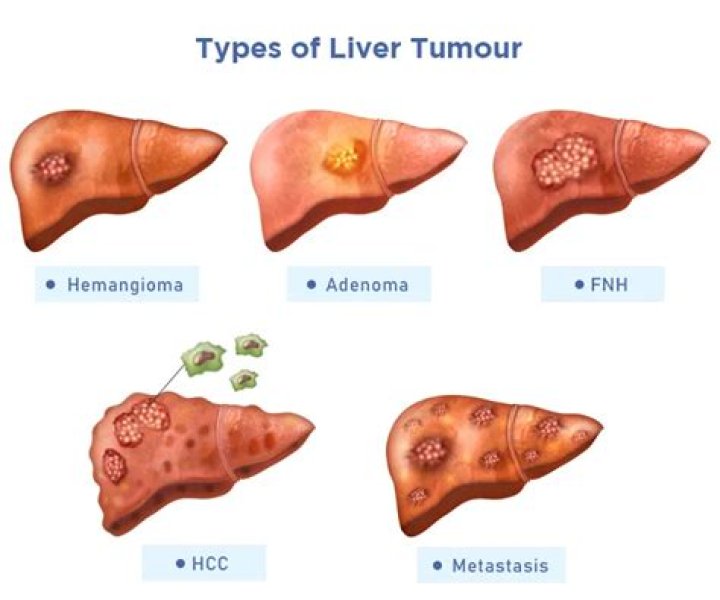 Is liver cancer usually primary or secondary?