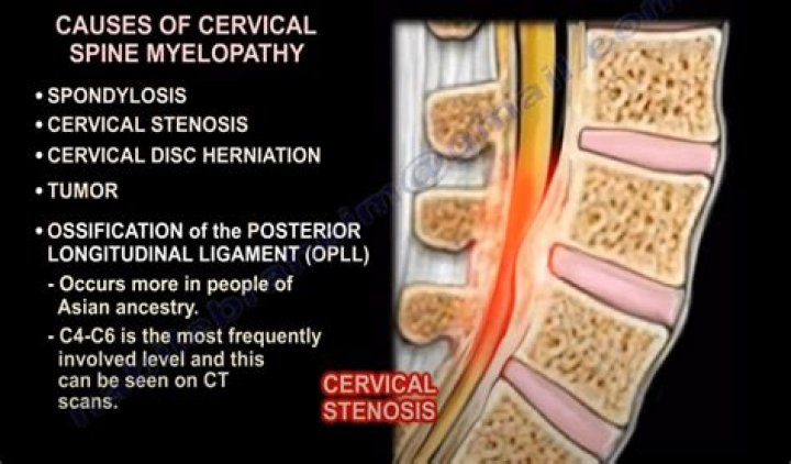 Is lumbar myelopathy serious?