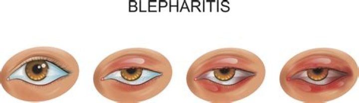 Is Meibomitis the same as blepharitis?