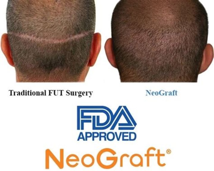 Is NeoGraft better than FUE?