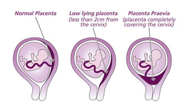 Is normal delivery possible with anterior placenta?