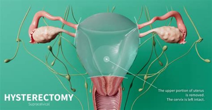 Is oophorectomy a major surgery?