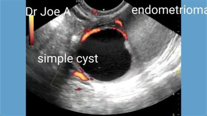 Is ovarian cyst and myoma the same?