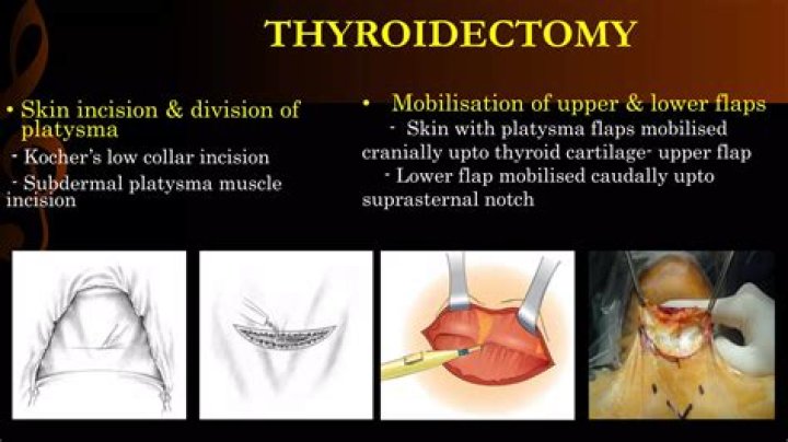 Is Rai necessary after thyroidectomy?