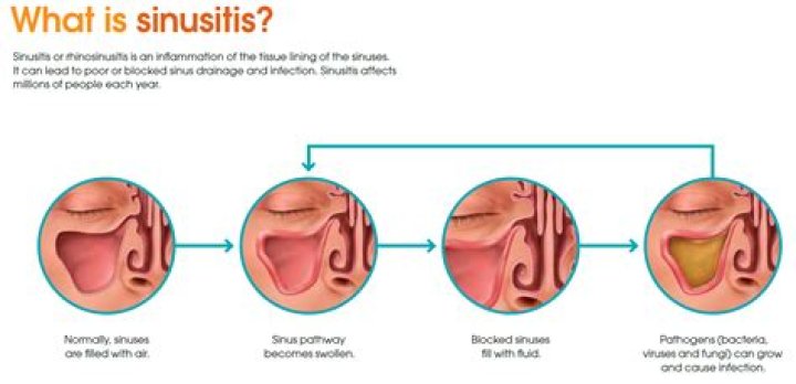 Is sinus very serious?