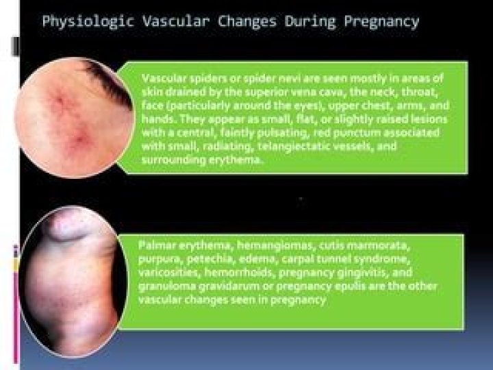 Is spider nevi normal in pregnancy?