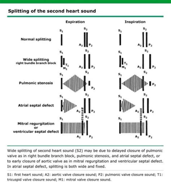 Is the second heart sound occasionally split?
