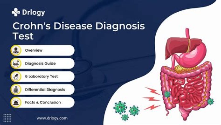 Is there a definitive test for Crohn disease?
