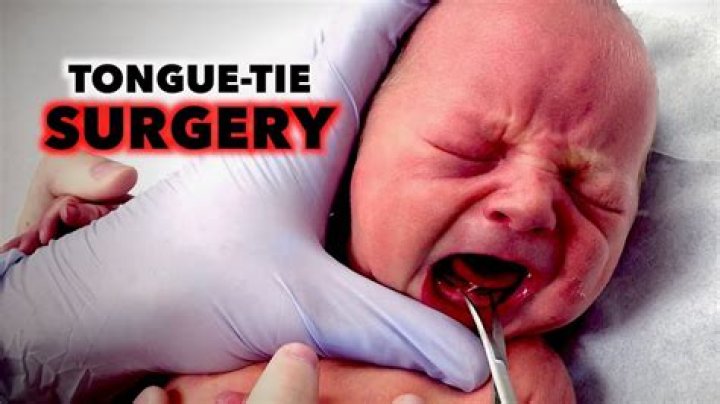 Is tongue tie surgery painful for babies?