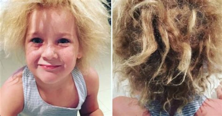 Is Uncombable Hair Syndrome Real?