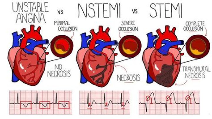 Is unstable angina the same as NSTEMI?