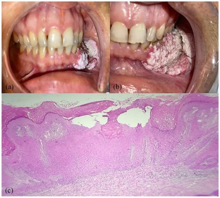 Is verrucous lesion cancerous?