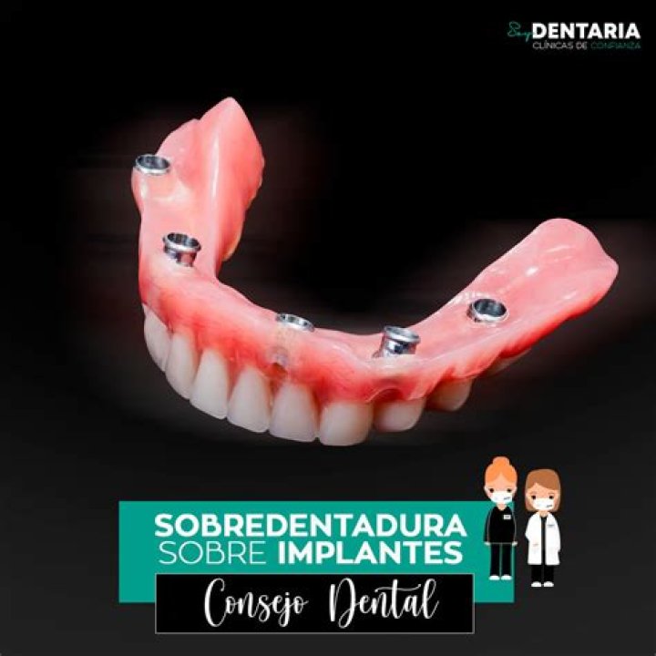 O que e dentadura de encaixe sobre implantes?
