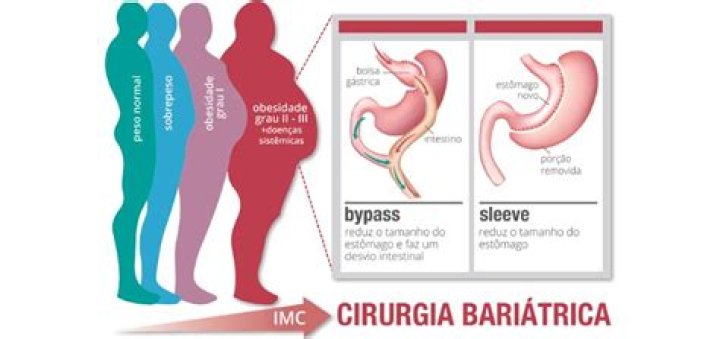 Qual o valor da cirurgia bariatrica sleeve?
